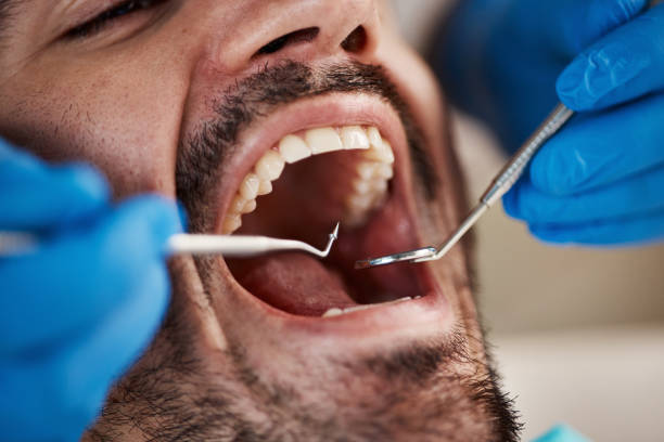 Best Emergency Dentist for Lost Fillings or Crowns in St Francis, KS